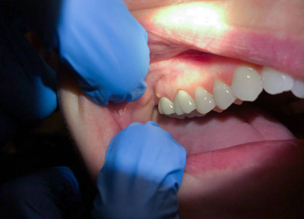 Best Tooth Infection Emergency Dentist  in Dry Run, OH